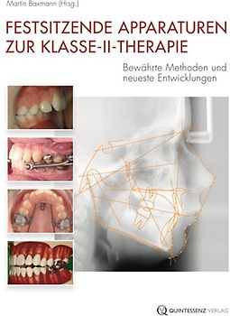 Festsitzende Apparaturen zur Klasse-II-Therapie