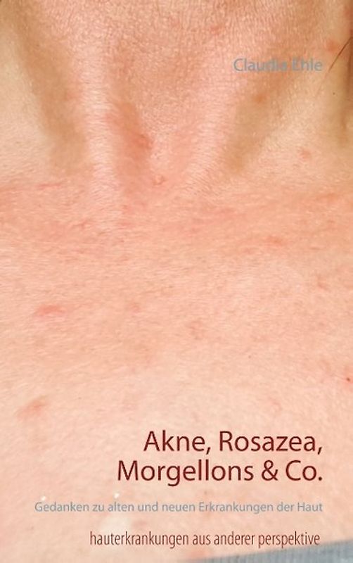 Akne, Rosazea, Morgellons & Co.. Gedanken zu alten und neuen Erkrankungen der Haut