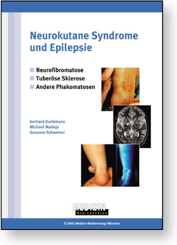 Neurokutane Syndrome und Epilepsie