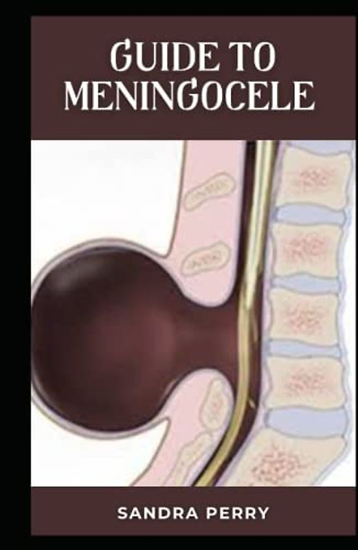 Guide to Meningocele: Meningocele is a type of spina bifida.