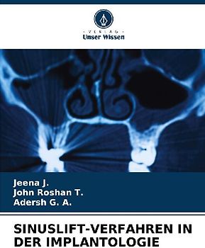 SINUSLIFT-VERFAHREN IN DER IMPLANTOLOGIE