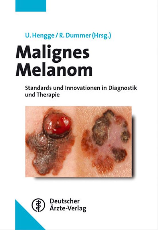 Malignes Melanom