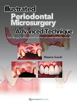 Illustrated Advanced Technique of Periodontal Microsurgery: Soft tissue management for the ultimate esthetic result: Advanced Technique Soft Tissue Management for the Ultimate Esthetic Result