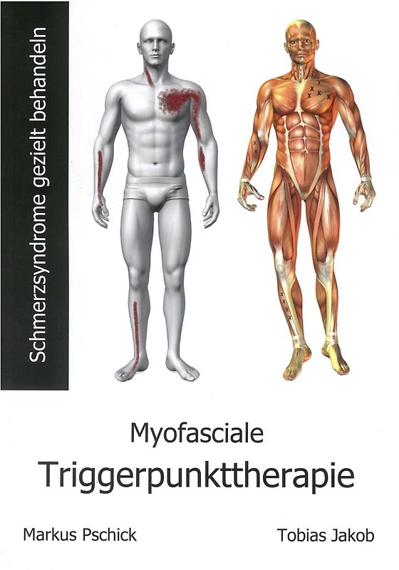 Myofasciale Triggerpunkttherapie