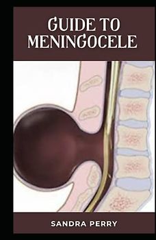 Guide to Meningocele: Meningocele is a type of spina bifida.