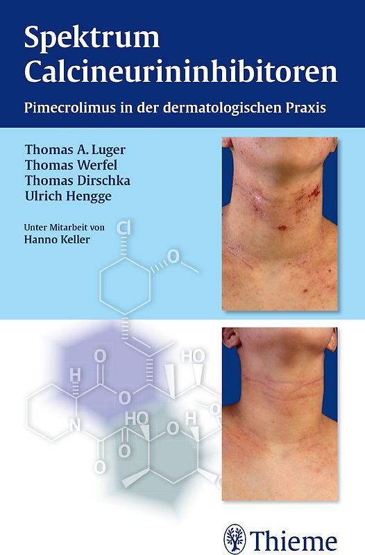 Spektrum Calcineurininhibitoren: Pimecrolimus in der dermatologischen Praxis