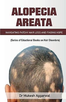 Alopecia Areata