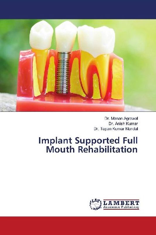 Implant Supported Full Mouth Rehabilitation