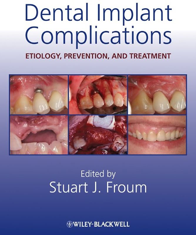 Dental Implant Complications
